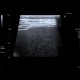 Ascites, echogenic ascites, perofration of stomach ulcer: US - Ultrasound