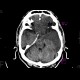 Brain edema, subfalcine herniation: CT - Computed tomography