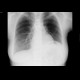 Elevation of left hemidiaphragm: X-ray - Plain radiograph