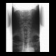 Elongated styloid process: X-ray - Plain radiograph