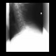 Elongated styloid process: X-ray - Plain radiograph