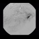 Bleeding into large bowel, embolisation: AG - Angiography