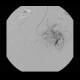 Bleeding into large bowel, embolisation: AG - Angiography