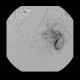 Bleeding into large bowel, embolisation: AG - Angiography