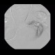 Bleeding into large bowel, embolisation: AG - Angiography