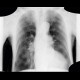 Lung emphysema: X-ray - Plain radiograph