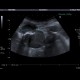 Emphysematous cholecystitis, pericholecystitic abscess: US - Ultrasound