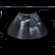 Emphysematous cholecystitis, pericholecystitic abscess: US - Ultrasound