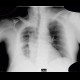 Empyema of thorax: X-ray - Plain radiograph