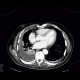 Empyema of thorax: CT - Computed tomography