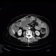 Jejuno-transverso-anastomosis, side-to-side, CT enterography: CT - Computed tomography