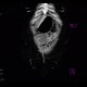 Jejuno-transverso-anastomosis, side-to-side, CT enterography: CT - Computed tomography