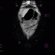 Jejuno-transverso-anastomosis, side-to-side, CT enterography: CT - Computed tomography
