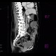 Jejuno-transverso-anastomosis, side-to-side, CT enterography: CT - Computed tomography