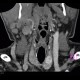 Thyroid nodule, enhancing: CT - Computed tomography