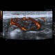 Enteritis, inflammation of small bowel: US - Ultrasound