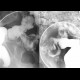 Entero-sigmoid fistula, enteroclysis: RF - Fluoroscopy