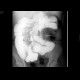 Adhesions, enteroclysis: RF - Fluoroscopy