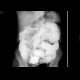 Adhesions, enteroclysis: RF - Fluoroscopy