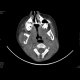 Eosinophilic granuloma of a bone: CT - Computed tomography