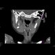 Eosinophilic granuloma of a bone: CT - Computed tomography