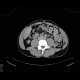 Fracture of thoracic vertebra, epidural hematoma of the spinal canal: CT - Computed tomography
