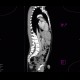 Fracture of thoracic vertebra, epidural hematoma of the spinal canal: CT - Computed tomography