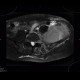 Ewing sarcoma, pelvis: MRI - Magnetic Resonance Imaging