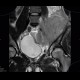 Ewing sarcoma, pelvis: MRI - Magnetic Resonance Imaging