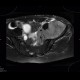 Ewing sarcoma, pelvis: MRI - Magnetic Resonance Imaging