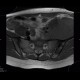 Ewing sarcoma, pelvis: MRI - Magnetic Resonance Imaging