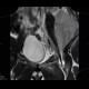 Ewing sarcoma, pelvis: MRI - Magnetic Resonance Imaging