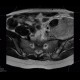 Ewing sarcoma, pelvis: MRI - Magnetic Resonance Imaging