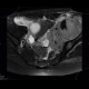 Ewing sarcoma, pelvis: MRI - Magnetic Resonance Imaging