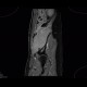 Ewing sarcoma, pelvis: MRI - Magnetic Resonance Imaging