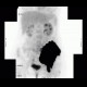 Ewing sarcoma, pelvis: NM - Nuclear medicine