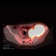 Ewing sarcoma, pelvis: NM - Nuclear medicine