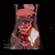 Ewing sarcoma, pelvis: NM - Nuclear medicine