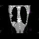 Ewing sarcoma of rib: CT - Computed tomography