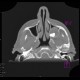 Follicular cyst in the maxillary sinus: CT - Computed tomography