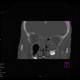 Follicular cyst in the maxillary sinus: CT - Computed tomography