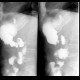 Oesophagitis, transpyloric prolapse: RF - Fluoroscopy