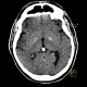 Accumulation of iron in the medial globus pallidus, globus pallidus internus: CT - Computed tomography