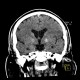 Accumulation of iron in the medial globus pallidus, globus pallidus internus: CT - Computed tomography