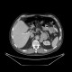 Pheochromocytoma, adrenal gland: CT - Computed tomography