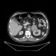 Pheochromocytoma, adrenal gland: CT - Computed tomography