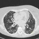 Lung fibrosis, advanced: CT - Computed tomography
