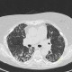 Lung fibrosis, advanced: CT - Computed tomography