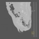 Gangrene of perineum and ischiorectal fossa, Fournier gangrene: CT - Computed tomography