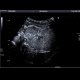 Focal nodular hyperplasia, CEUS: US - Ultrasound